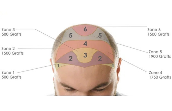 FUE Technique for Beard Transplant